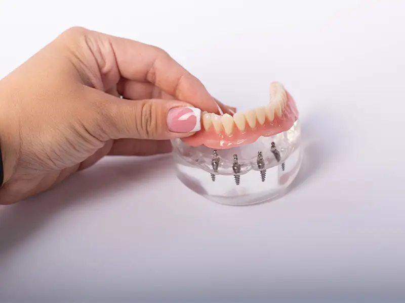 Protesi Dentali Fisse - Genzano