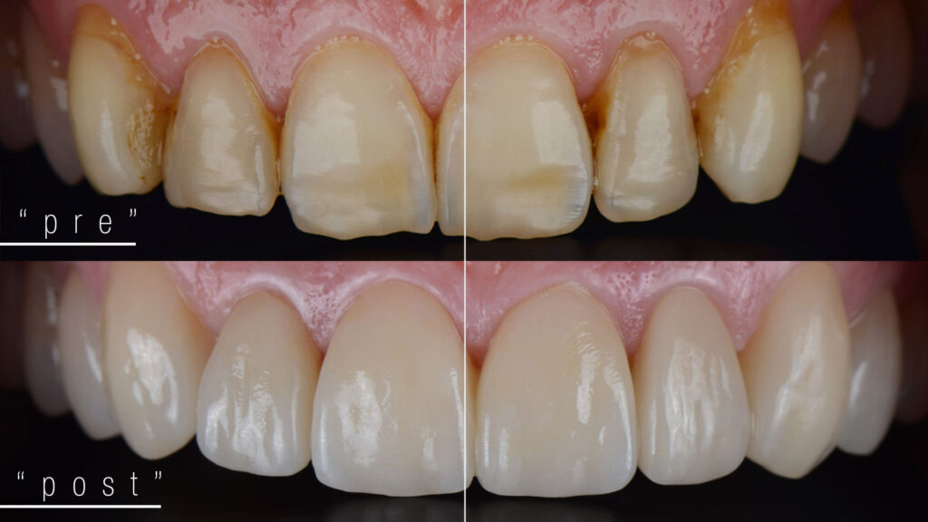 Faccette dentali - Genzano
